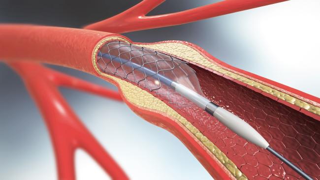 Im Bereich der Medizintechnik gilt es, neue biologisch abbaubare metallische Werkstoffe für Implantate zu entwickeln und skalenübergreifend zu charakterisieren.